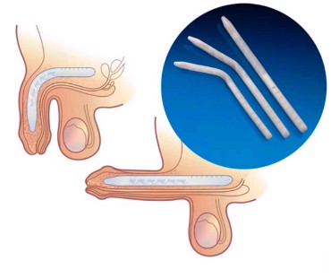 Prótese Peniana Maleável - Dr. Diego Moura